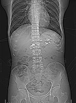 File:Chronic calcific pancreatitis (Radiopaedia 5532-7278 Scanogram 1).jpg