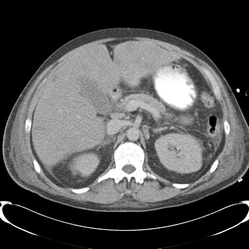 Chronic diverticulitis complicated by hepatic abscess and portal vein thrombosis (Radiopaedia 30301-30938 A 34).jpg