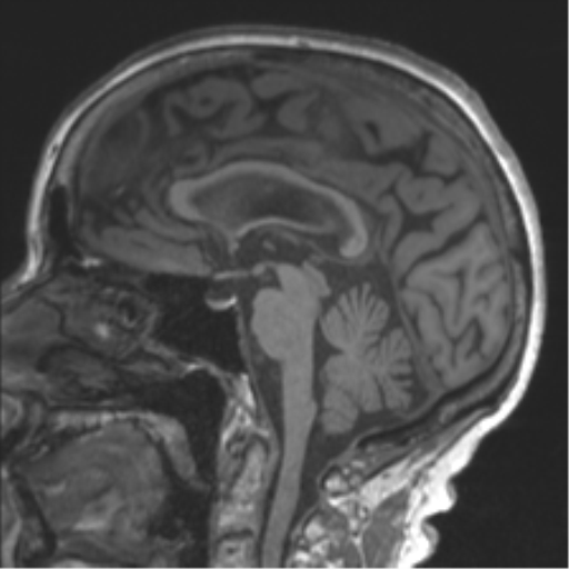 Chronic hypertensive encephalopathy (Radiopaedia 39993-42482 Sagittal T1 49).png