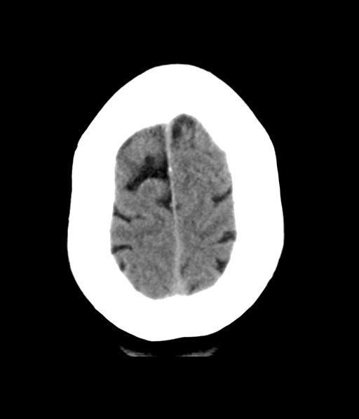 File:Chronic hypertensive encephalopathy (Radiopaedia 39993-42485 Axial non-contrast 29).png