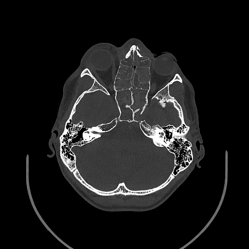 Chronic invasive fungal sinusitis (Radiopaedia 50342-55710 Axial bone window 72).jpg