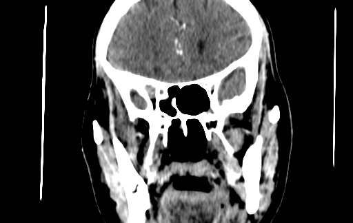 Chronic invasive fungal sinusitis (Radiopaedia 91563-109286 D 73).jpg