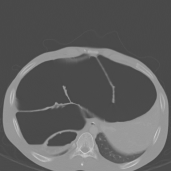 Chronic large bowel pseudo-obstruction (Radiopaedia 43181-46492 Axial bone window 42).jpg
