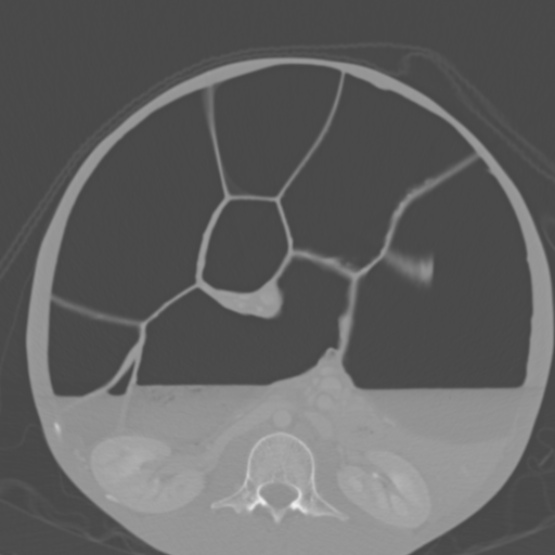 Chronic large bowel pseudo-obstruction (Radiopaedia 43181-46492 Axial bone window 88).jpg