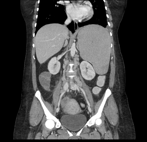 File:Chronic myeloid leukemia with splenic infarction (Radiopaedia 9178-9874 C 1).jpg
