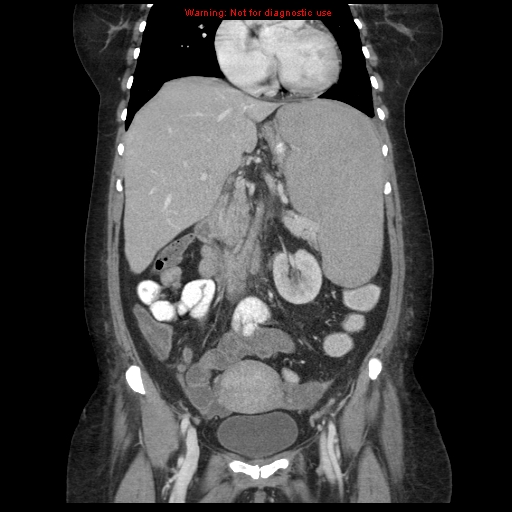 File:Chronic myeloid leukemia with splenic infarction (Radiopaedia 9178-9874 E 28).jpg