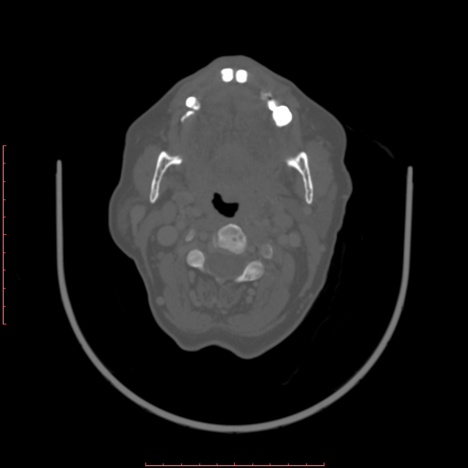 Chronic osteomyelitis - maxilla (Radiopaedia 23783-23927 Axial bone window 51).jpg