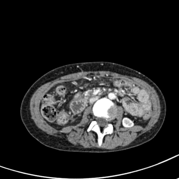 File:Chronic pancreatitis (Radiopaedia 55405-61846 A 52).jpg