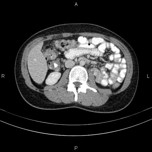File:Chronic pancreatitis (Radiopaedia 64576-73450 C 80).jpg