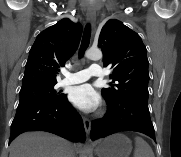 Chronic pulmonary embolus (Radiopaedia 39129-41341 Coronal C+ CTPA 46).png