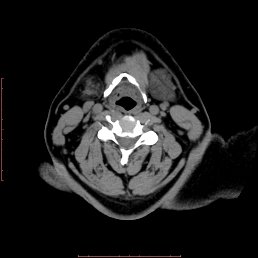 File:Chronic submandibular sialolithiasis (Radiopaedia 69817-79814 Axial non-contrast 141).jpg