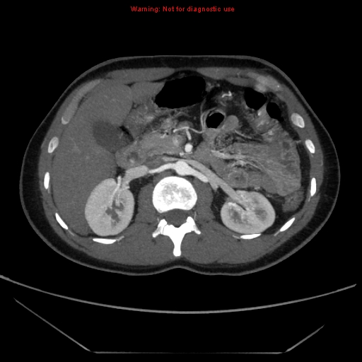 File:Circumaortic left renal vein (Radiopaedia 9069-9792 A 17).jpg
