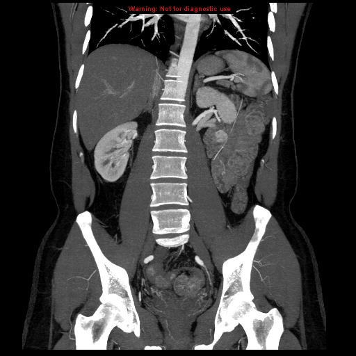 File:Circumaortic left renal vein (Radiopaedia 9069-9792 B 23).jpg