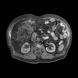 File:Cirrhosis and hepatocellular carcinoma in the setting of hemochromatosis (Radiopaedia 75394-86594 Axial T1 C+ fat sat 19).jpg