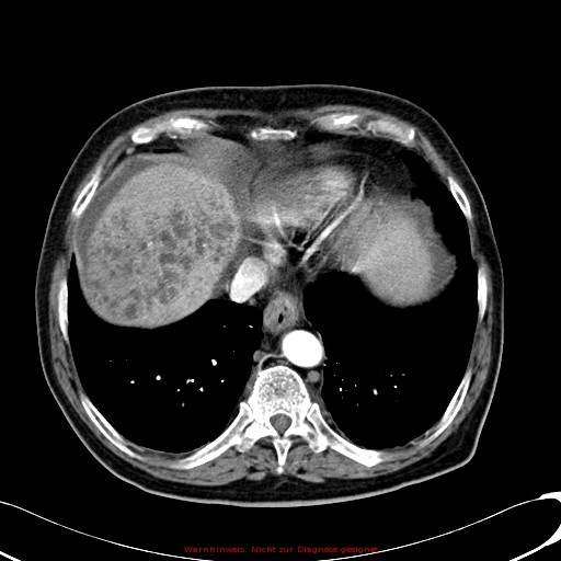 File:Cirrhosis and hepatocellular carcinoma in the setting of hemochromatosis (Radiopaedia 75394-86595 A 17).jpg