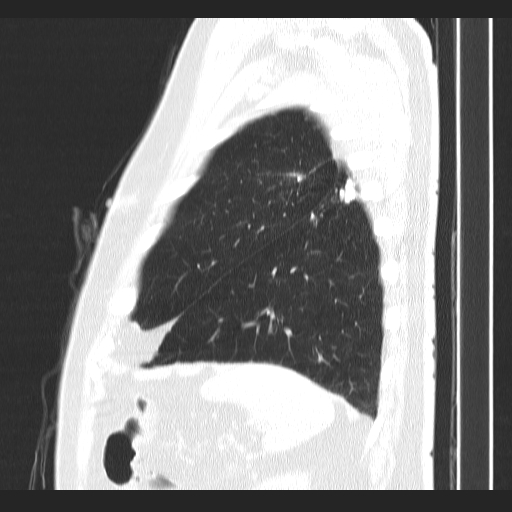 Classic complicated silicosis (Radiopaedia 49720-54961 Sagittal lung window 11).jpg
