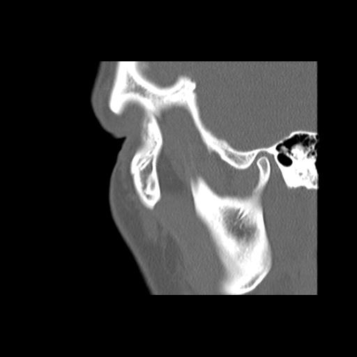 Cleft hard palate and alveolus (Radiopaedia 63180-71710 Sagittal bone window 11).jpg