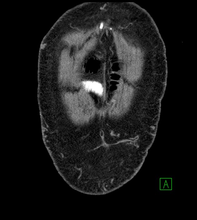 Closed-loop small bowel obstruction-internal hernia (Radiopaedia 78439-91096 Coronal non-contrast 16).jpg
