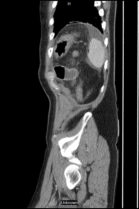 Closed loop bowel obstruction and ischemia (Radiopaedia 86959-103180 C 4).jpg