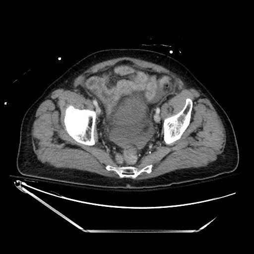 File:Closed loop obstruction due to adhesive band, resulting in small bowel ischemia and resection (Radiopaedia 83835-99023 D 134).jpg