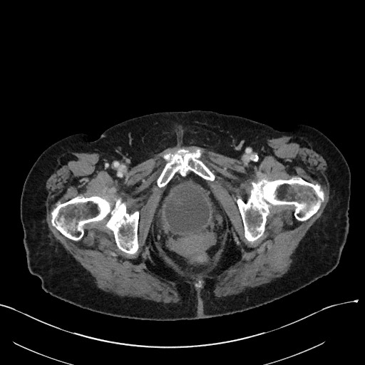 Closed loop small bowel obstruction - adhesions (Radiopaedia 59269-66611 A 132).jpg
