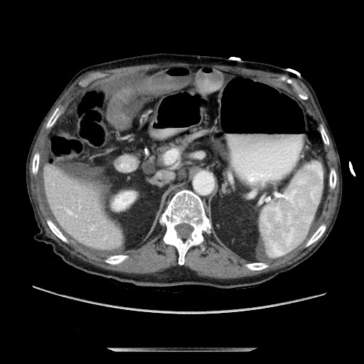 Closed loop small bowel obstruction - adhesive disease and hemorrhagic ischemia (Radiopaedia 86831-102990 A 65).jpg