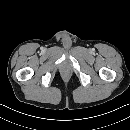 Closed loop small bowel obstruction - internal hernia (Radiopaedia 57806-64778 B 136).jpg