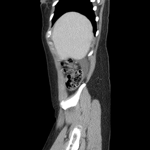 Closed loop small bowel obstruction due to trans-omental herniation (Radiopaedia 35593-37109 C 11).jpg