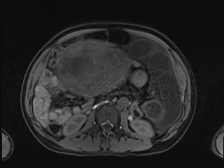 Closed loop small bowel obstruction in pregnancy (MRI) (Radiopaedia 87637-104031 Axial T1 fat sat 62).jpg