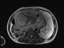 File:Closed loop small bowel obstruction in pregnancy (MRI) (Radiopaedia 87637-104031 Axial T2 38).jpg
