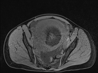 Closed loop small bowel obstruction in pregnancy (MRI) (Radiopaedia 87637-104031 F 49).jpg