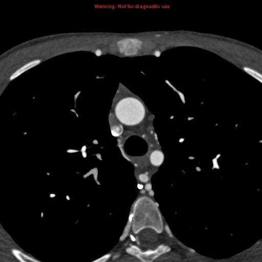 File:Coarctation of the aorta (Radiopaedia 12461-12697 A 106).jpg