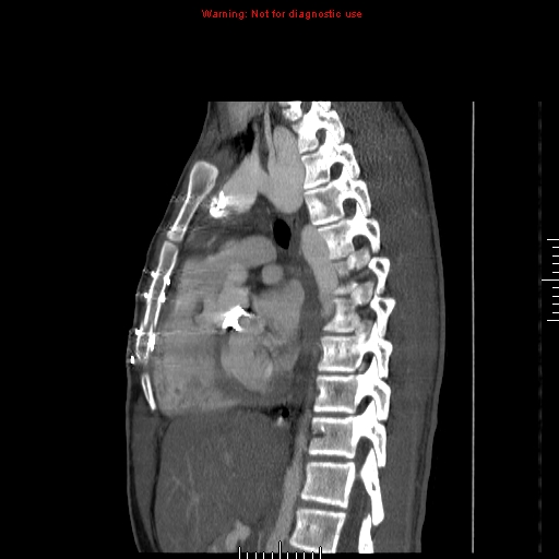 File:Coarctation of the aorta (Radiopaedia 9434-10118 B 31).jpg
