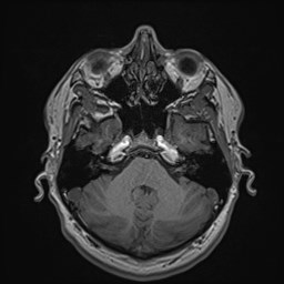 Cochlear incomplete partition type III associated with hypothalamic hamartoma (Radiopaedia 88756-105498 Axial T1 60).jpg