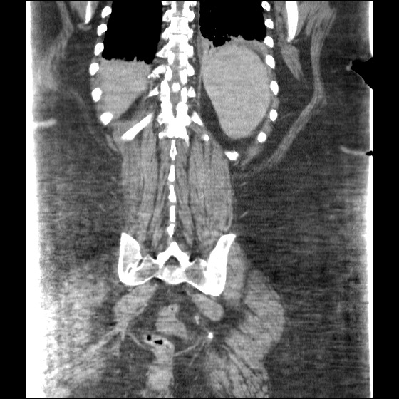 File:Collection due to leak after sleeve gastrectomy (Radiopaedia 55504-61972 B 37).jpg