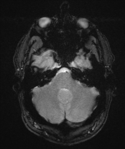 File:Colloid cyst (Radiopaedia 44510-48181 Axial Gradient Echo 7).png