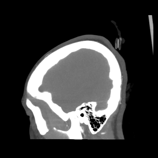 File:Colloid cyst (resulting in death) (Radiopaedia 33423-34499 B 8).png