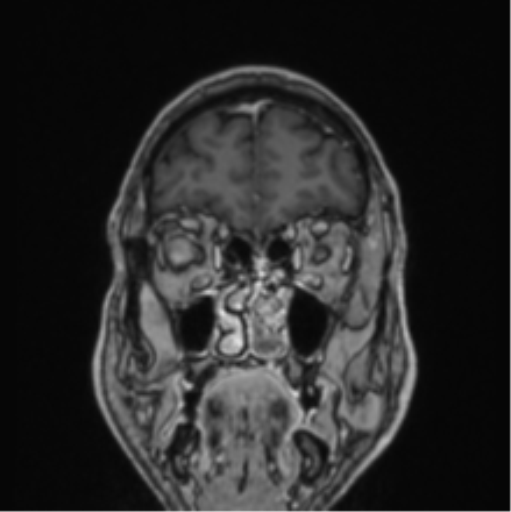 File:Colloid cyst of the third ventricle (Radiopaedia 86571-102662 Coronal T1 C+ 77).png