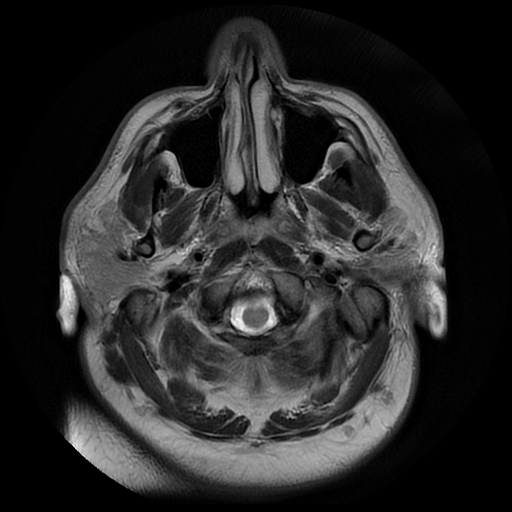 File:Colloid cyst with anterior communicating artery aneurysm (Radiopaedia 33901-35091 Axial T2 1).jpg
