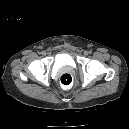 File:Colo-cutaneous fistula (Radiopaedia 40531-43129 A 94).jpg
