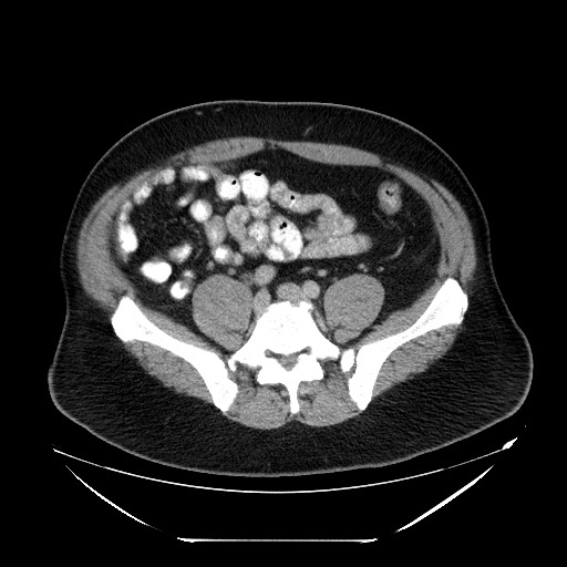 Colocolic intussusception due to lipoma (Radiopaedia 73712-84508 A 81).jpg