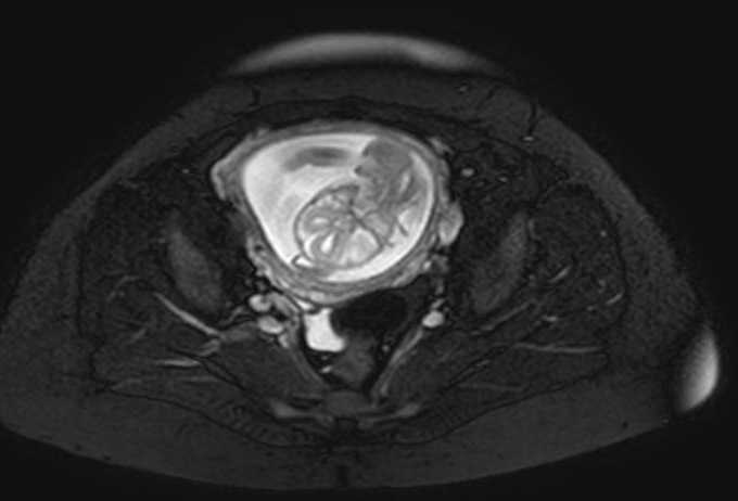 Colon adenocarcinoma with Krukenberg tumors, advanced pregnancy (Radiopaedia 67279-76645 Axial T2 SPAIR 15).jpg