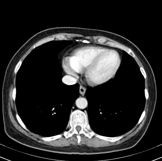 Colon carcinoma with hepatic metastases (Radiopaedia 29477-29961 A 7).jpg