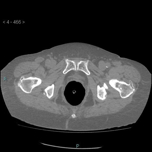 Colonic lipomas (Radiopaedia 49137-54244 Axial bone window 208).jpg