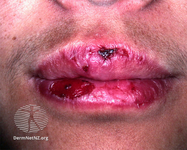 Cutaneous lupus erythematosus (DermNet NZ immune-lupus-erythematosus-2558).jpg