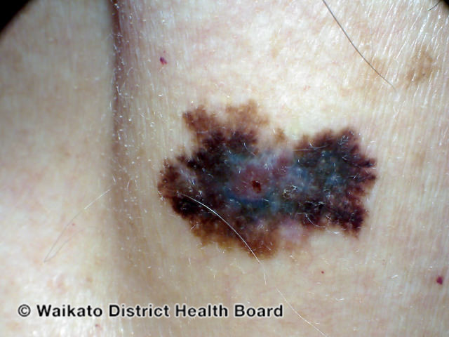 File:Invasive melanoma (DermNet NZ melanoma-abcd-10).jpg