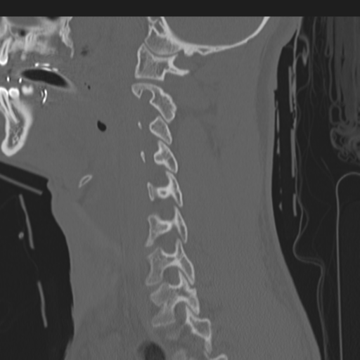 File:Multitrauma with diffuse axonal injury, temporal bone fractures and traumatic caroticocavernous fistula (Radiopaedia 37242-39035 Sagittal 22).png