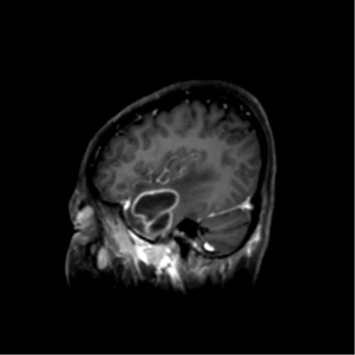 File:Nasopharyngeal carcinoma with cerebral abscess (Radiopaedia 43018-46274 J 17).png