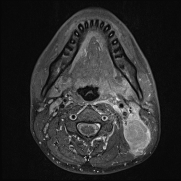 File:Nasopharyngeal carcinoma with skull base invasion (Radiopaedia 53415-59485 Axial T1 C+ fat sat 44).jpg
