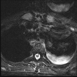 File:Nasopharyngeal carcinoma with skull base invasion (Radiopaedia 59258-66600 Axial T2 fat sat 30).jpg